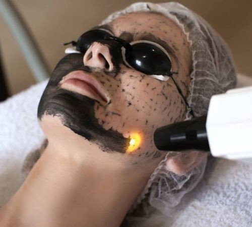 Carbon kuorinta laserilla